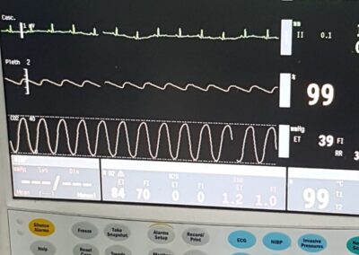 Curve da pacemaker